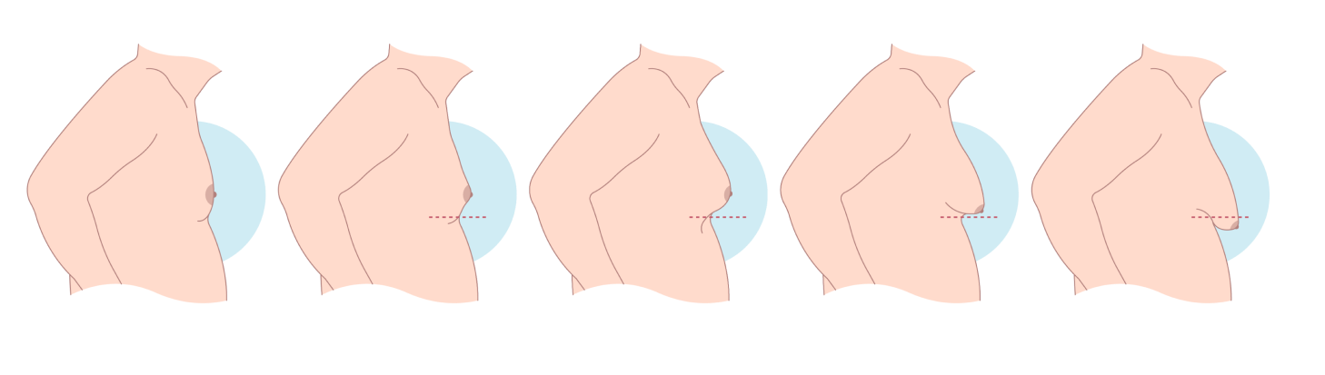 Five profile illustrations showing progressive stages of facial contouring or liposuction results