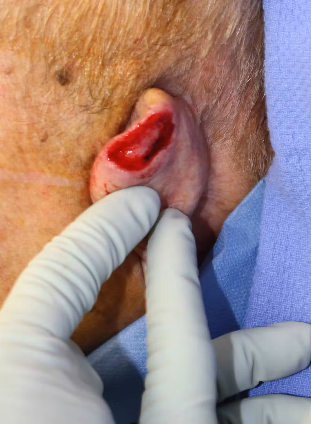 1596659094-left-ear-basal-cell-cancer-post-resection-dr-mussman-jpg
