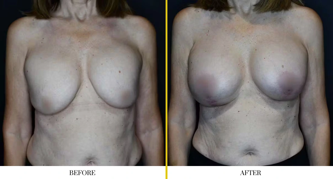 Before and after breast augmentation, front view comparison