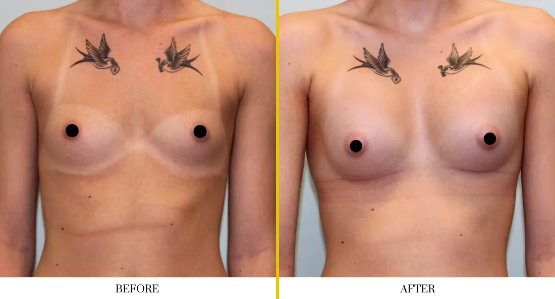 Before and after breast augmentation showing enhanced projection and fuller appearance