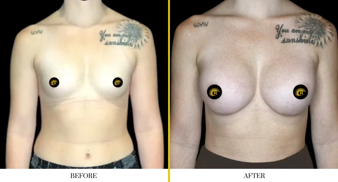 Breast augmentation before and after, frontal view