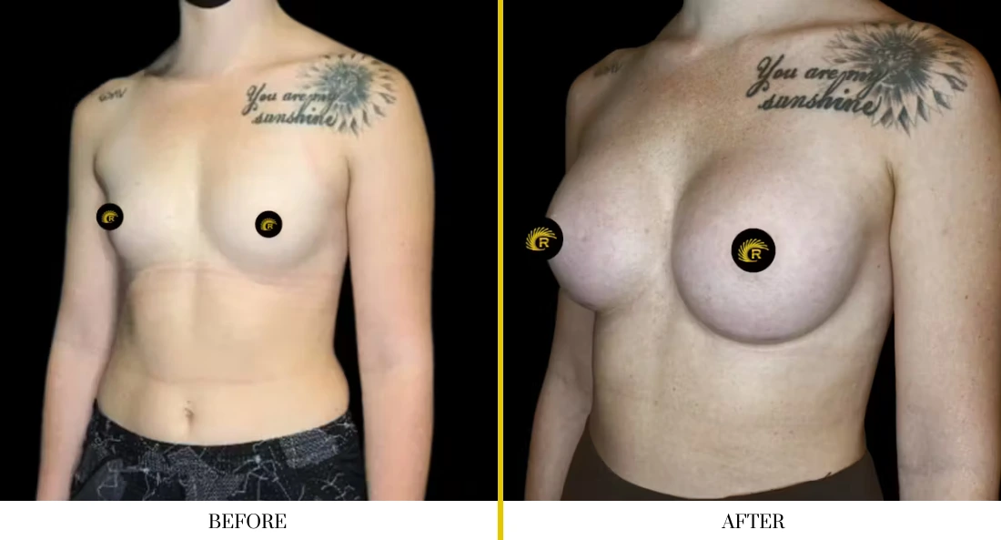 Breast augmentation before and after, frontal view