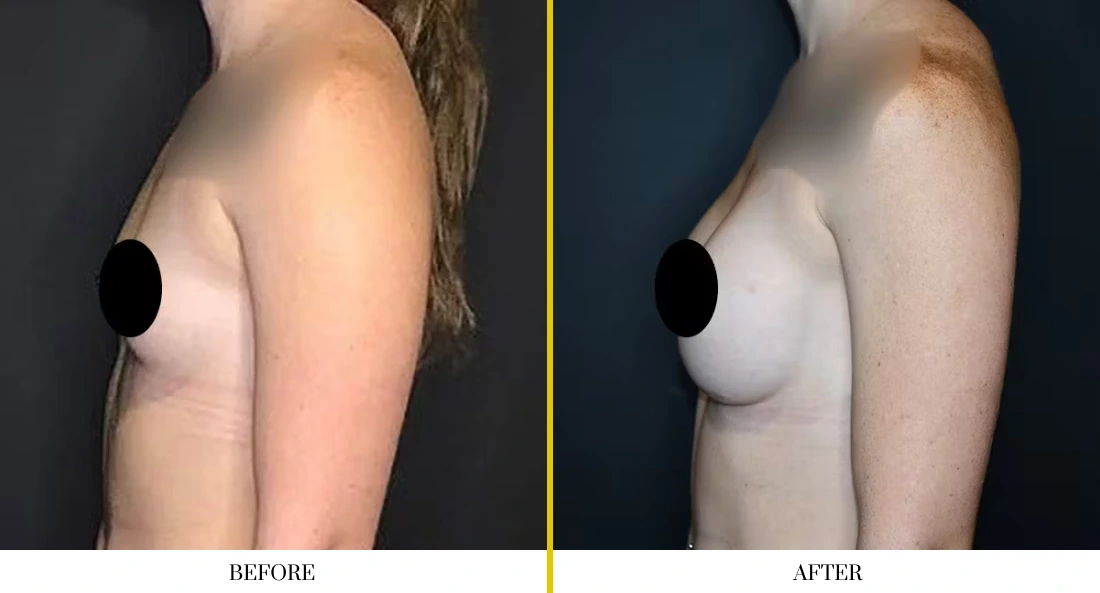 Side profile before and after breast augmentation showing improved projection and shape