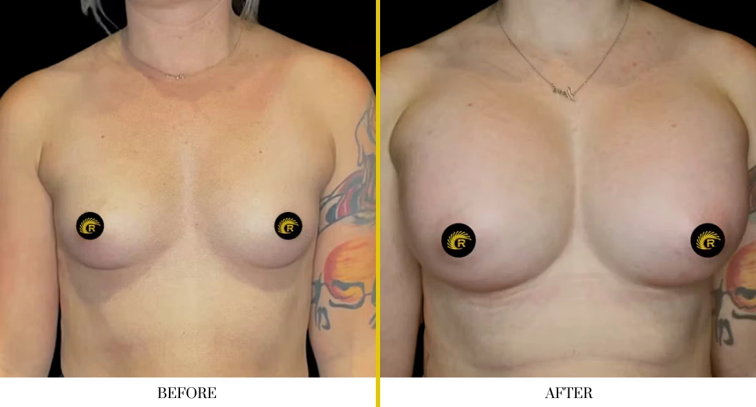 Breast augmentation before and after comparison, frontal view