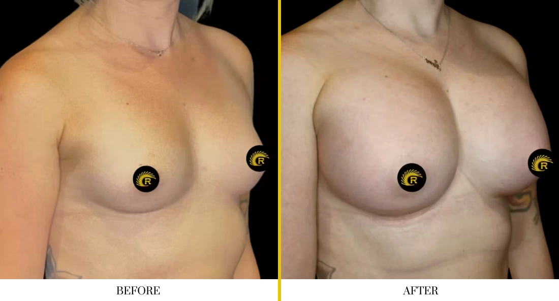 Breast augmentation before and after, angled frontal view
