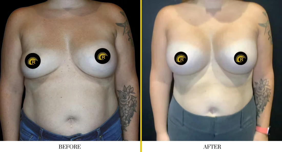 Breast augmentation before and after comparison, frontal view