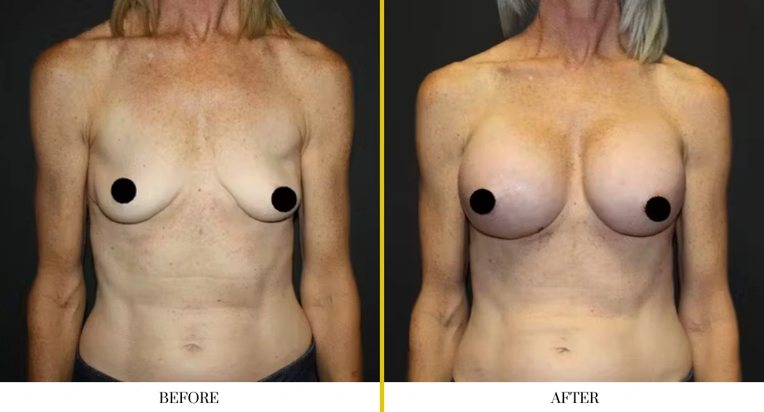 Breast augmentation before and after comparison, frontal view