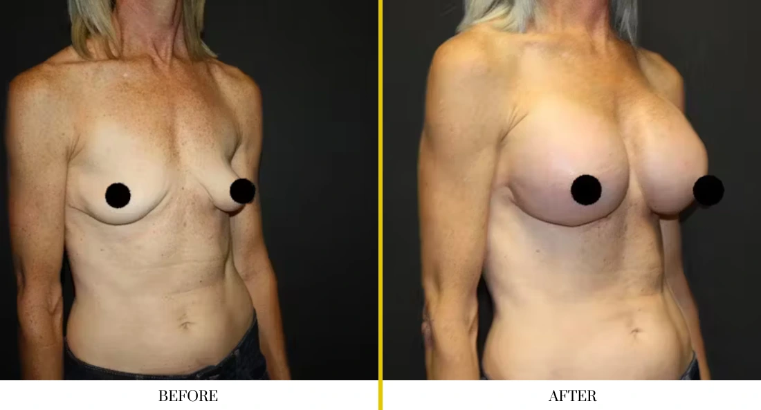Breast augmentation before and after comparison, frontal view