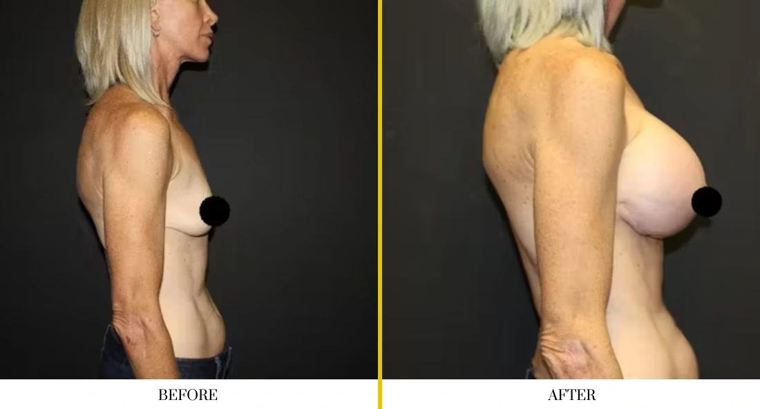 Breast augmentation before and after comparison, side profile view