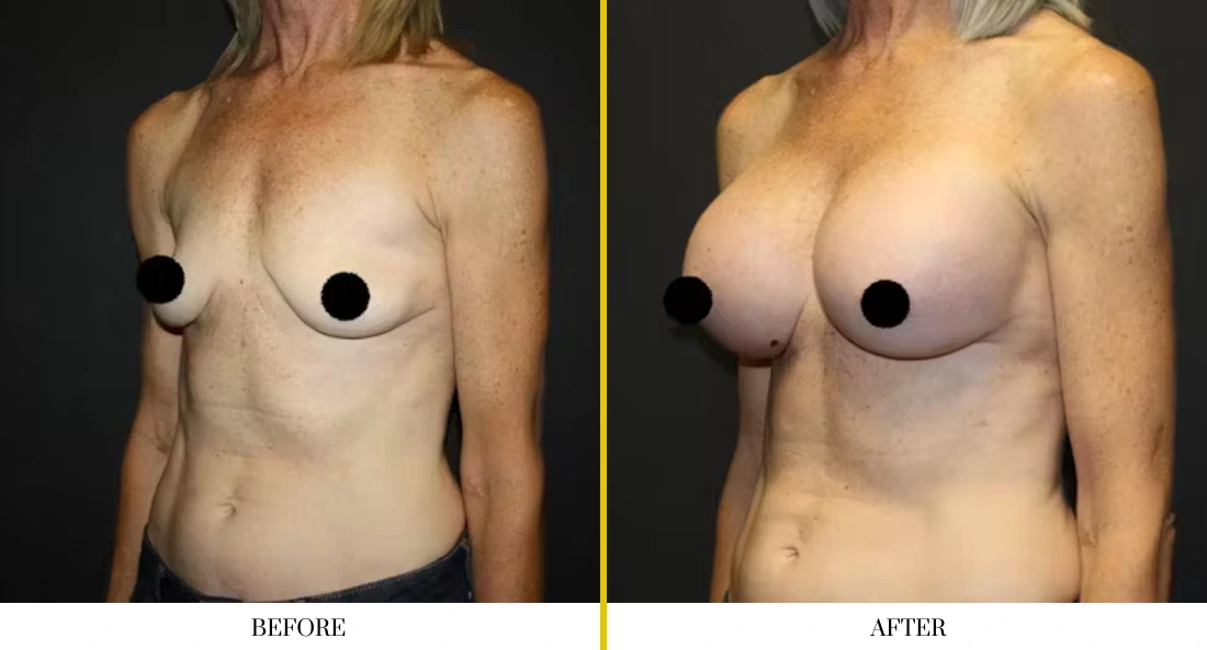 Breast augmentation before and after comparison, side profile view