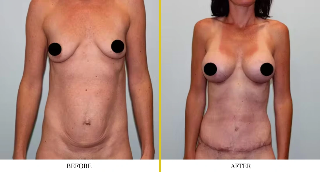 Before and after breast augmentation frontal view showing improved volume and shape