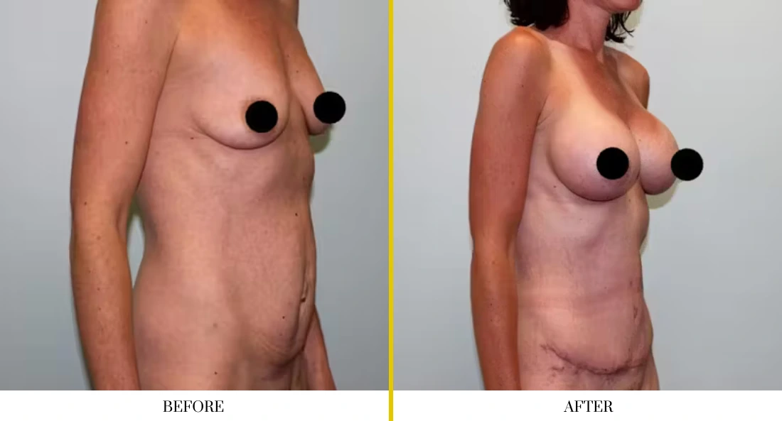 Breast augmentation before and after comparison, side view