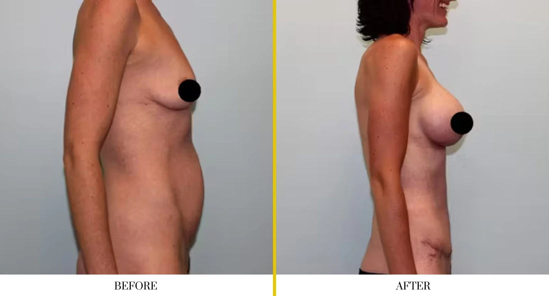 Breast augmentation before and after comparison, side view