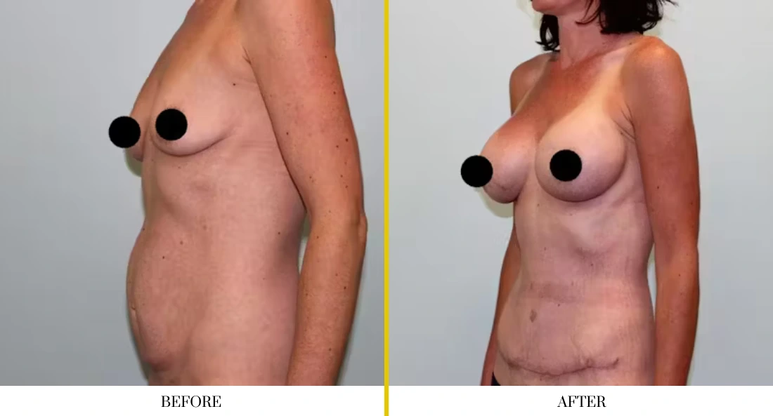 Breast augmentation before and after comparison, side view