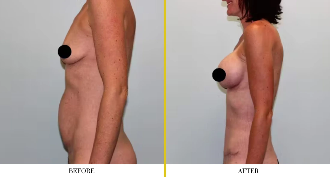 Breast augmentation before and after comparison, side view