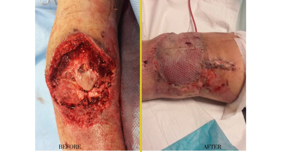 Before and after extremity reconstruction showing lower leg wound healing to closed incision