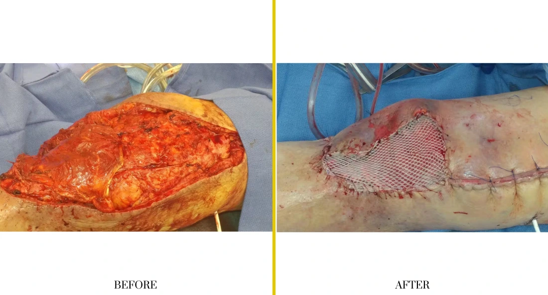 Before and after extremity reconstruction: large open wound on forearm versus healed scar with mesh graft