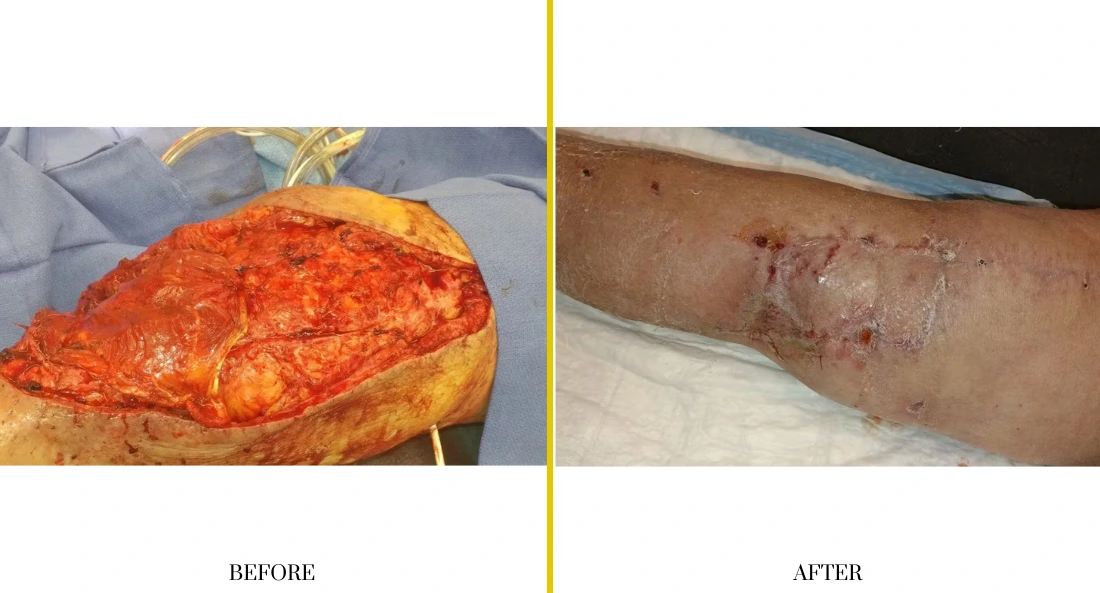 Before and after extremity reconstruction: large open wound on forearm versus healed surgical scar