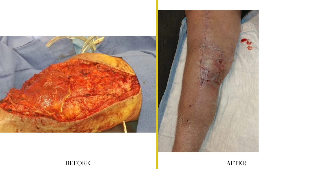 Before and after extremity reconstruction: left shows large excised wound on leg; right shows healed surgical closure on lower leg