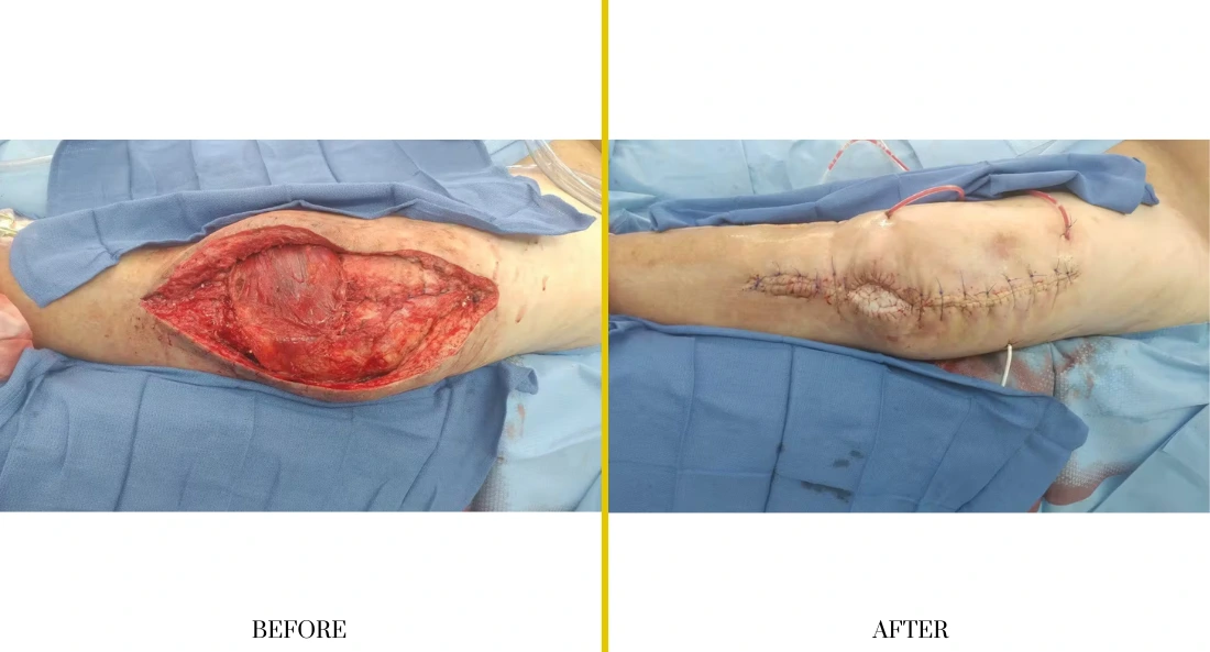 Before and after extremity reconstruction: large open wound on forearm versus healed surgical scar
