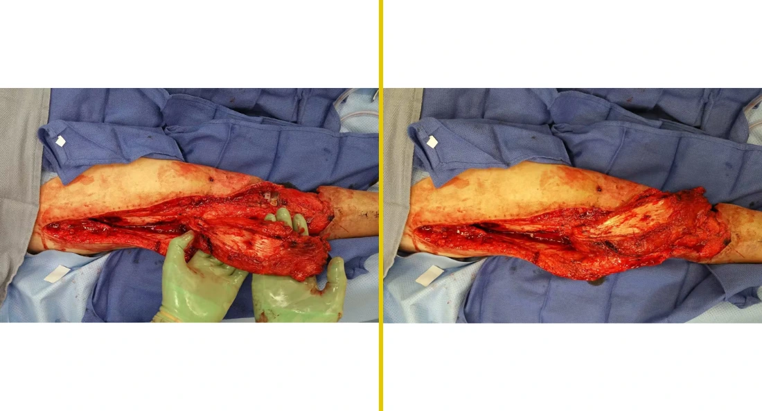 Extremity Reconstruction (41)