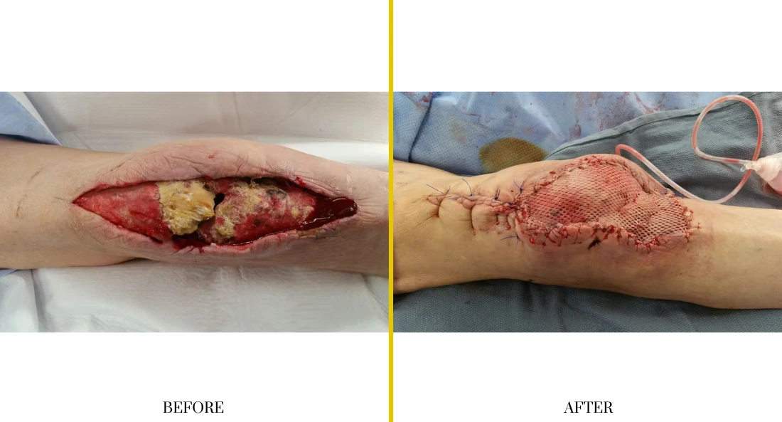 Before and after extremity reconstruction: left shows severe open wound on forearm, right shows healed surgical site with minimal scarring