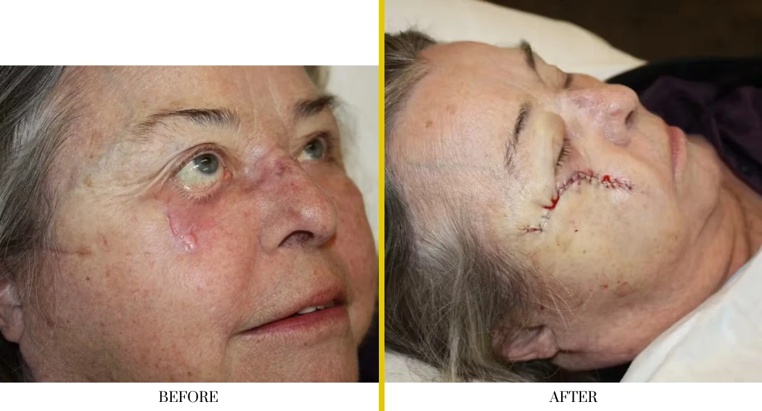 Before and after facial reconstruction: large facial lesion with redness before surgery, healed surgical site with sutures after reconstruction