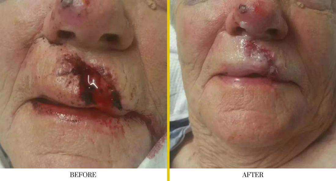 Before and after lip area lesion removal and wound healing