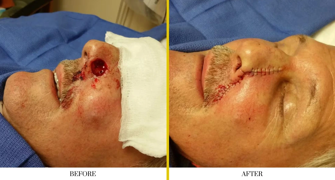 Before and after cheek wound closure with surgical sutures