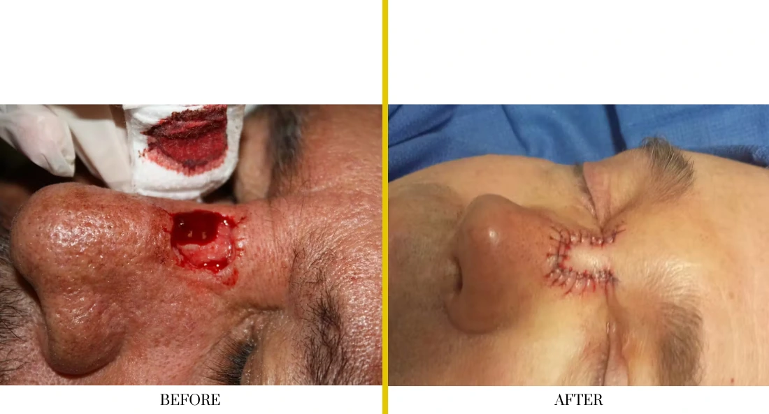 Before and after surgical removal of facial lesion on chin with healed scar