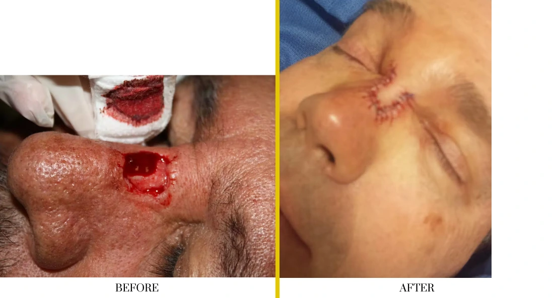 Before and after forehead lesion removal and wound closure