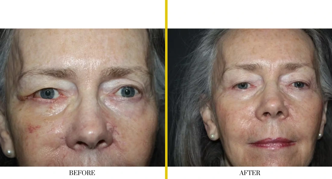 Before and after facial treatment showing smoother skin and reduced under-eye puffiness on woman's face