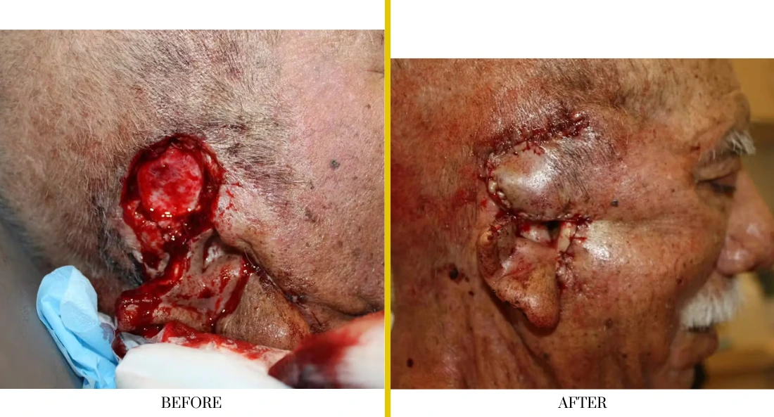 Before and after facial wound treatment demonstrating healing progress of cheek and jaw defect