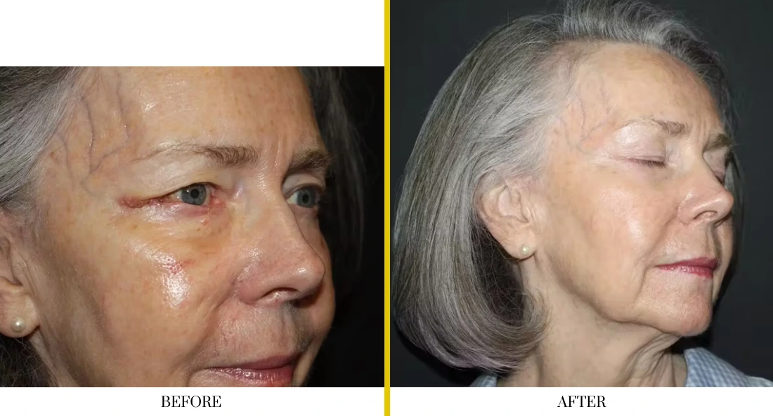 Before and after facial treatment showing improved skin texture and reduced wrinkles on woman's face in profile