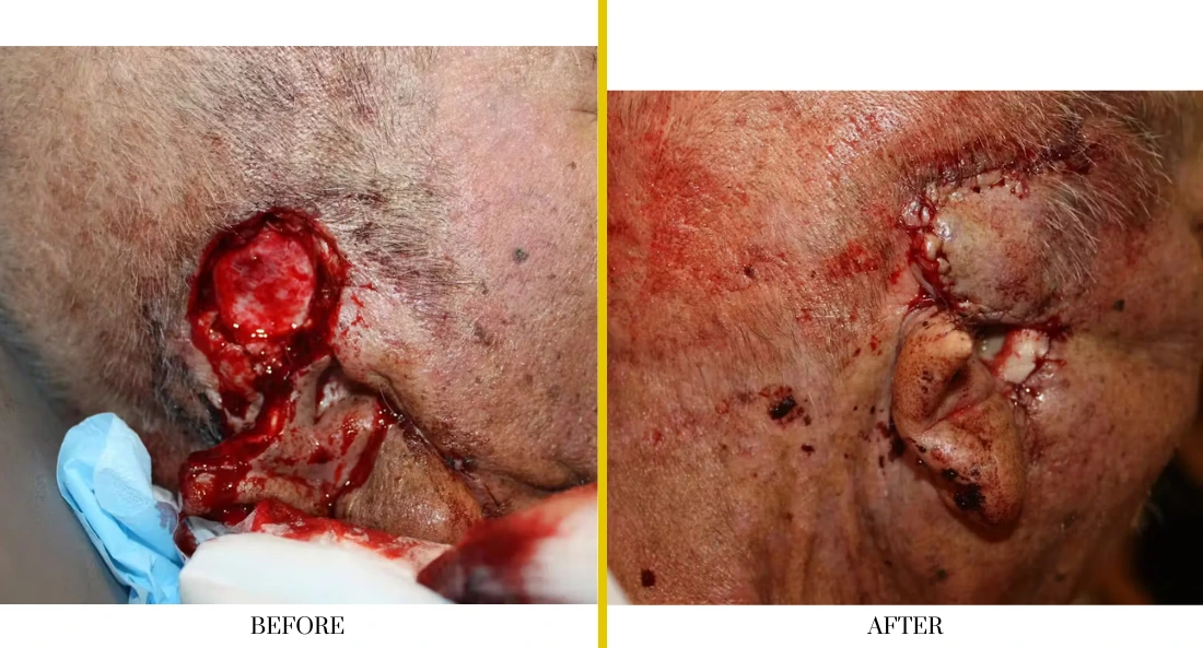 Before and after facial wound healing showing significant improvement in cheek and jaw area lesion