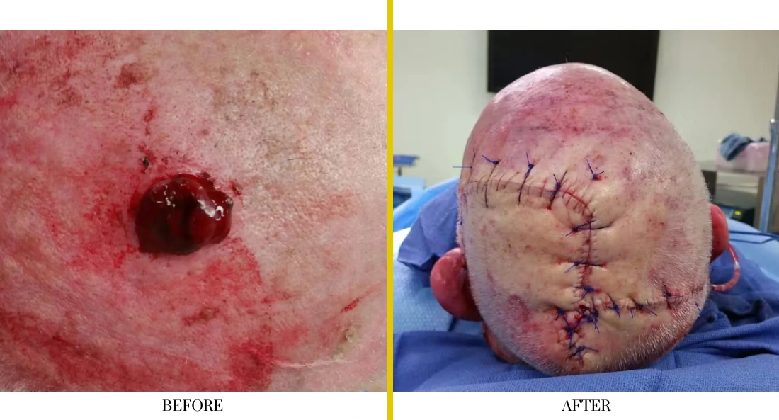 Before and after facial reconstruction: deep wound on scalp before surgery, sutured incision after surgical repair