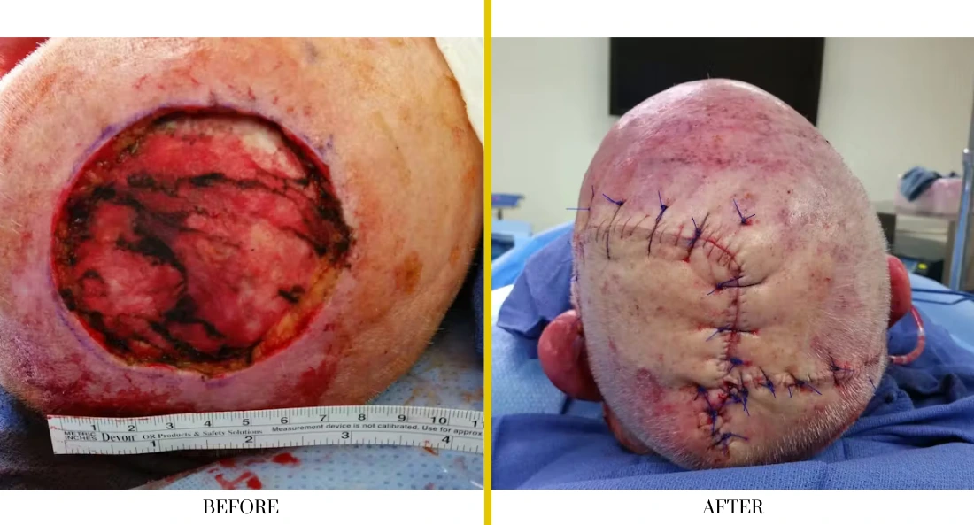 Before and after scalp defect surgical reconstruction showing wound closure and healing