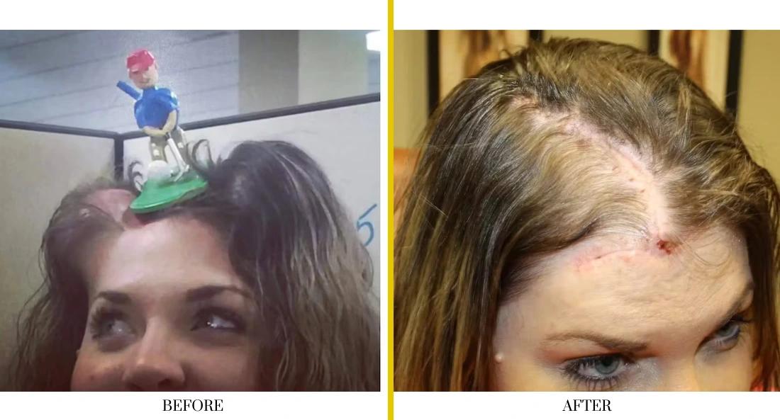 Before and after forehead laceration repair: deep cut above eyebrow before surgery, well-healed incision after suture removal