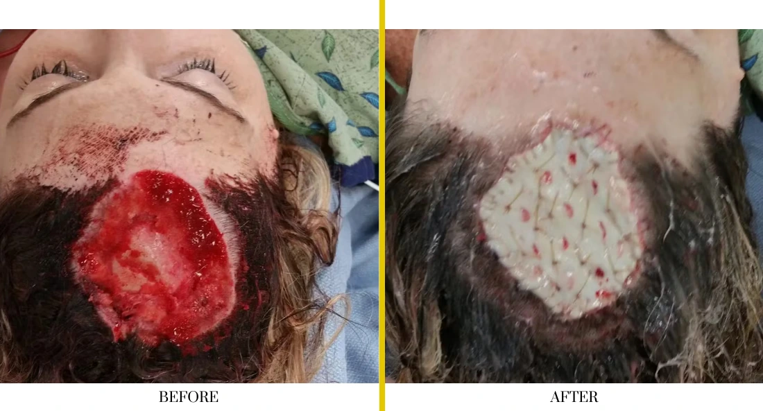 Before and after facial wound repair: large open lesion on cheek and beard area before treatment, healed surgical site after closure