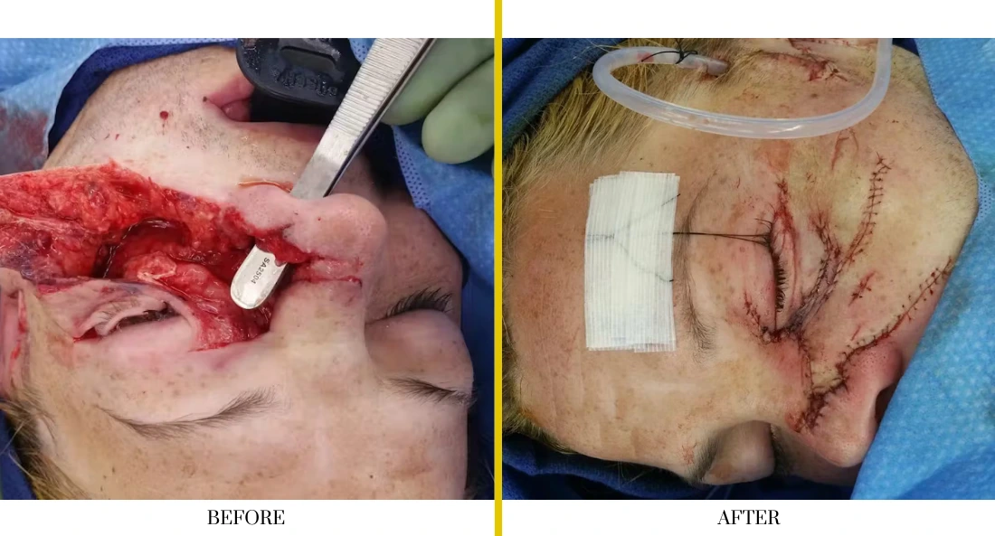 Before and after chin and jaw wound repair: large open injury before treatment, sutured and bandaged incision after surgical closure