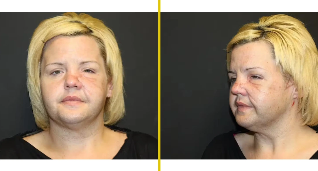Front and profile views of patient's face showing improved facial contour and reduced swelling after cosmetic facial procedure
