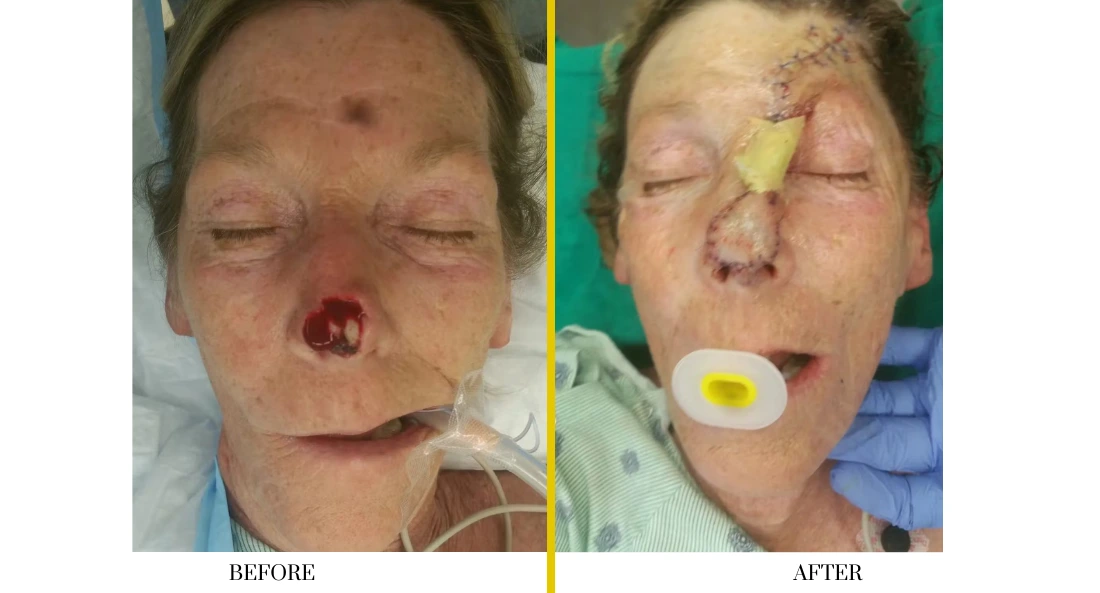 Before and after facial treatment showing surgical site healing and skin restoration