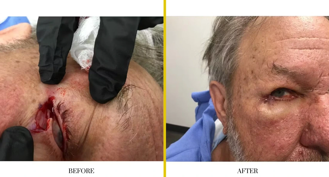 Before and after facial lesion removal on forehead, showing wound healing progression