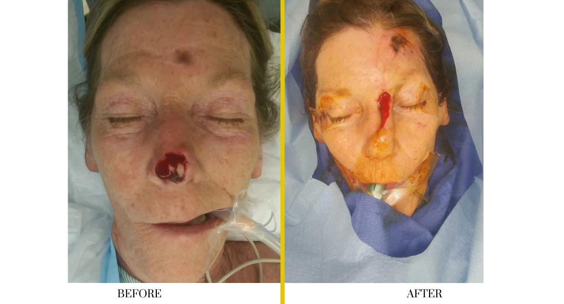 Before and after facial treatment showing surgical healing progress with reduced inflammation