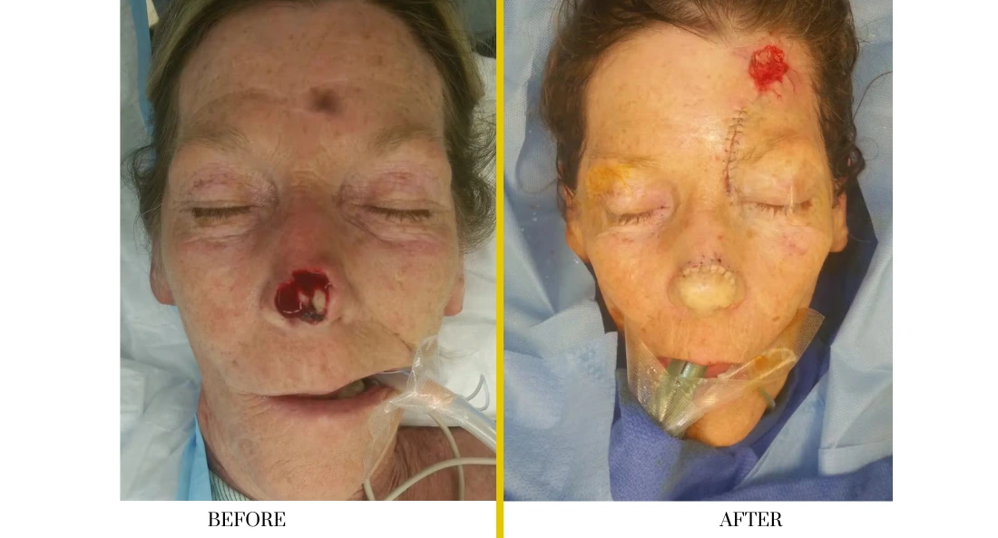 Before and after facial treatment showing surgical healing with reduced swelling and improved skin tone