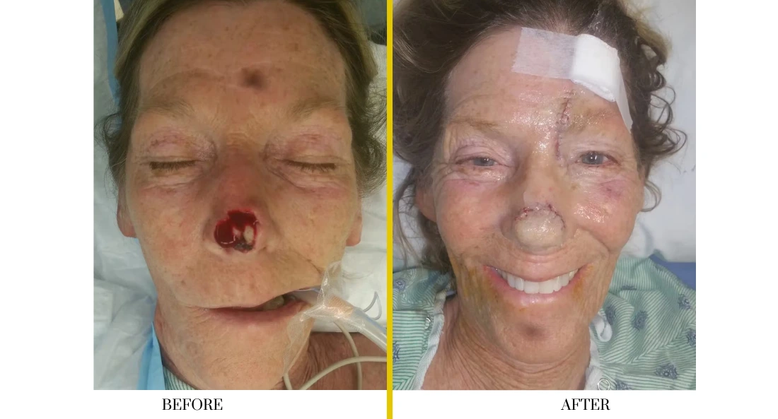 Before and after facial treatment showing healing of nasal lesion and improved skin appearance