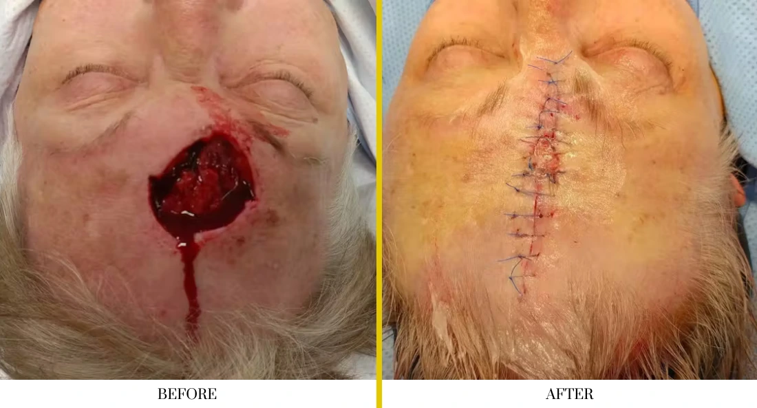 Before and after facial wound closure on nose with surgical stitches