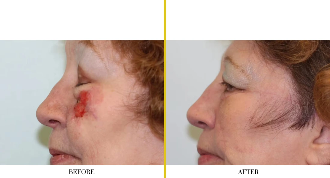 Facial and MOHS Reconstruction (2)