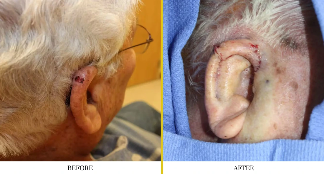 Facial and MOHS Reconstruction 2