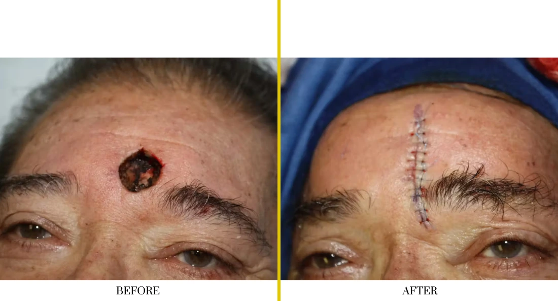 Before and after cranioplasty: patient with forehead lesion (left) and healed surgical site with sutures (right)
